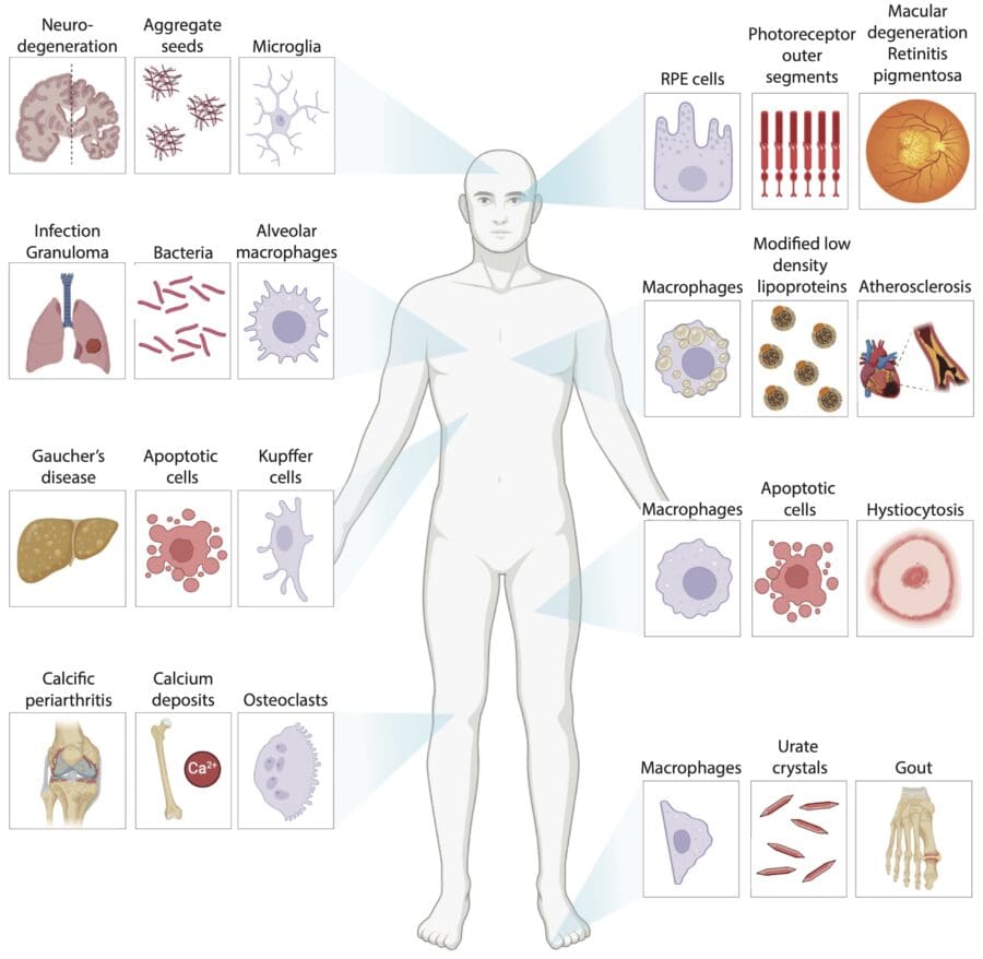 Human body schematic showcasing diverse deposit-related diseases at different bodily locations, highlighting phagocytes, phagocytic prey, and disorders for each tissue.