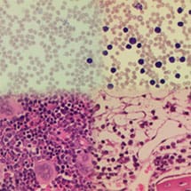 Fanconi Anaemia Ancohol