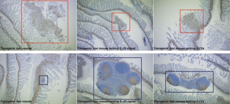 Intestinal micrographs illustrate reduced adenoma formation and altered lymphoid structures in Apc mice lacking IL-25 signaling or ILC2s.