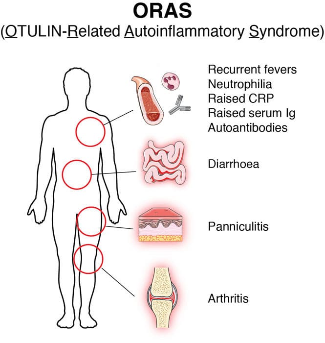 Graphical depiction of symptoms of ORAS (OTULIN-related Autoinflammatory Syndrome)