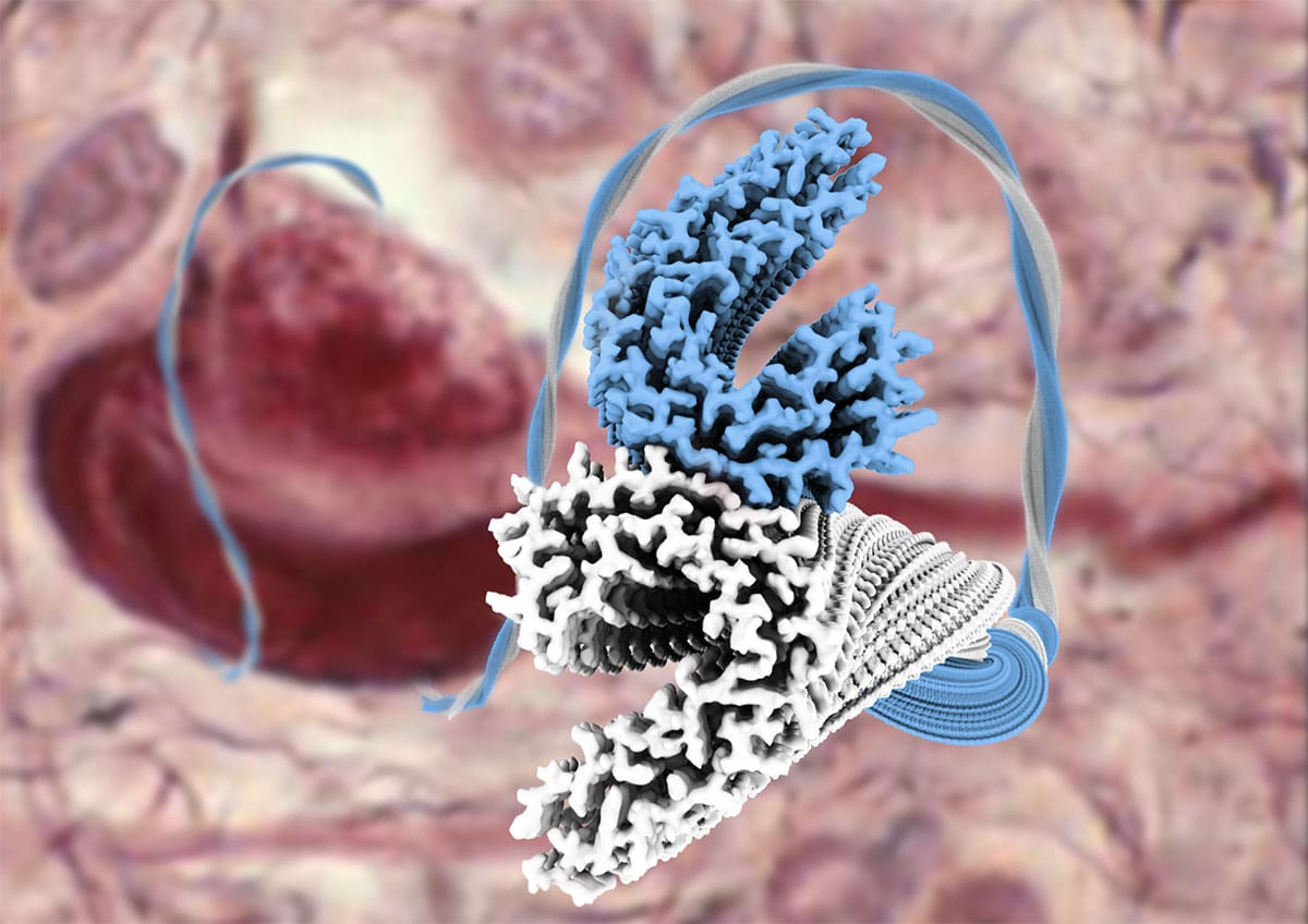 Atomic structures of Tau filaments from Alzheimer’s disease brain
