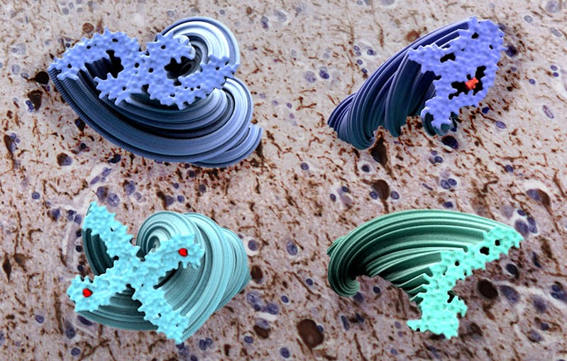 Models of tau filaments from four diseases. Clockwise from top left: Alzheimer’s disease, corticobasal degeneration, Pick’s disease, and chronic traumatic encephalopathy